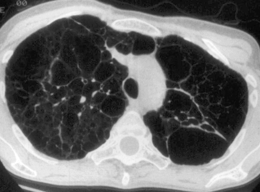 High-resolution CT scan showing diffuse cystic lung disease in LAM