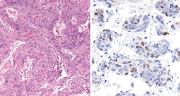 Histopathology showing LAM cell proliferation under the microscope