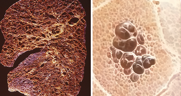 LAM disease tissue illustration